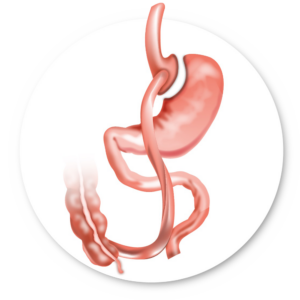 Bypass gastrique