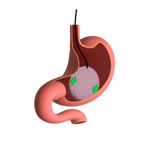 Ballon gastrique