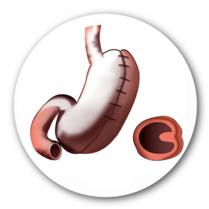 Plicature gastrique