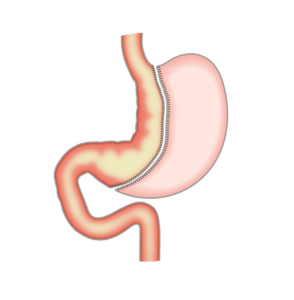Sleeve gastrectomie